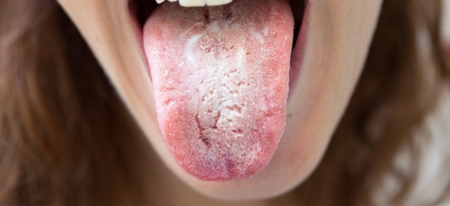 Khi nhiễm nấm Candida, người bệnh có những mảng trắng ở lưỡi 
