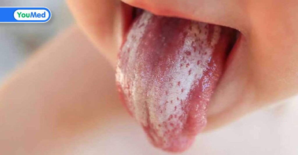 Dấu hiệu nhiễm nấm Candida miệng và phương pháp điều trị