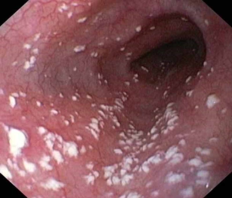 Nhiễm nấm Candida ở miệng có thể gây biến chứng đến thực quản