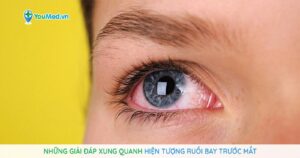 Những giải đáp xung quanh hiện tượng ruồi bay trước mắt