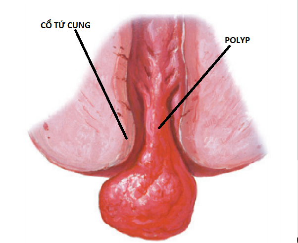 Polyp nội mạc tử cung nằm hẳn vào lòng âm đạo