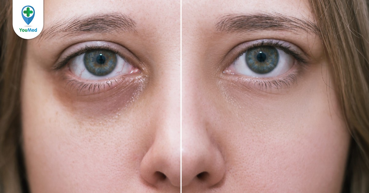 Quy trình sử dụng đá để làm sạch vùng da dưới mắt và làm giảm quầng thâm mắt như thế nào?
