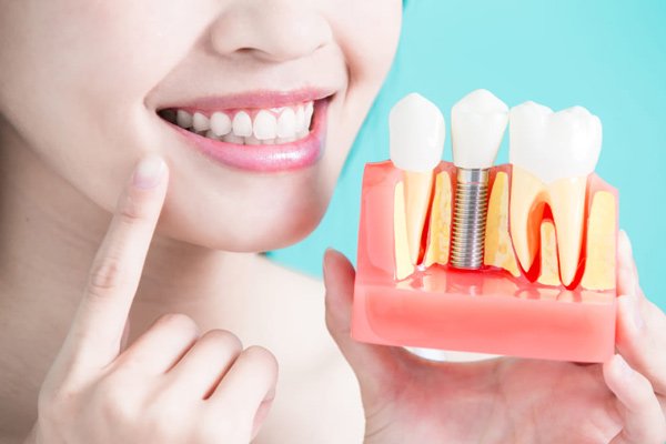 Implant có tính thẩm mỹ cao