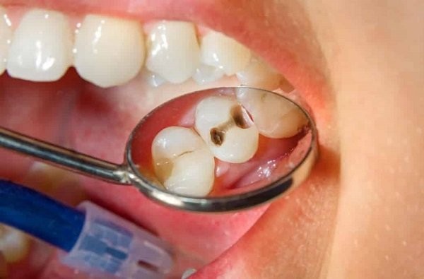 Chẩn đoán răng bị sâu trên lâm sàng