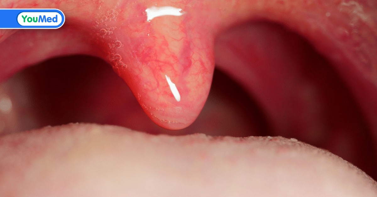 Hình ảnh viêm lưỡi gà liên quan đến những triệu chứng nào?