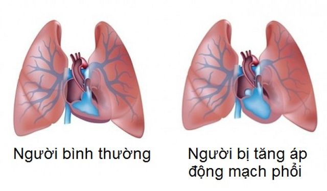 So sánh phổi người bình thường và phổi bệnh nhân bị tăng áp 