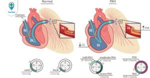 Những điều bạn cần biết về tăng áp phổi