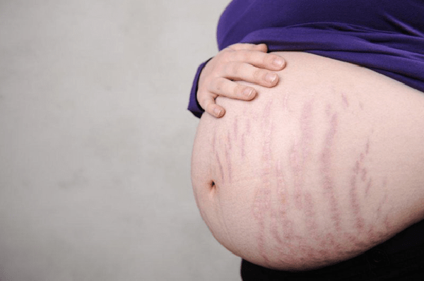 Mang thai tuần 25: Những vết rạn da mới màu hồng, đỏ