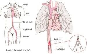 Thuyên tắc động mạch phổi