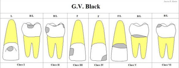 Phân loại xoang trám theo Greene Vardiman Black