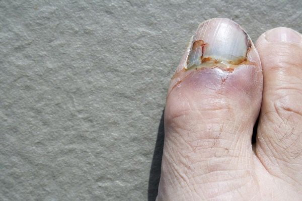 Gãy xương ngón chân: Triệu chứng, chẩn đoán và cách điều trị