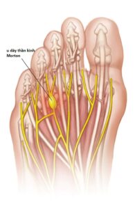 u dây thần kinh morton