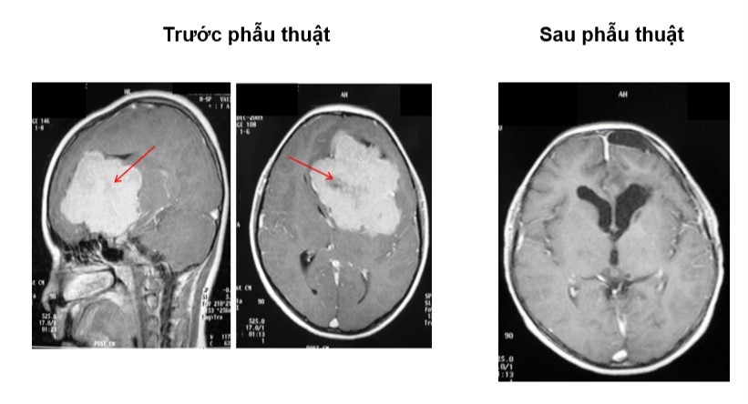 Hình ảnh MRI của một khối u màng não, trước và sau khi phẫu thuật lấy u