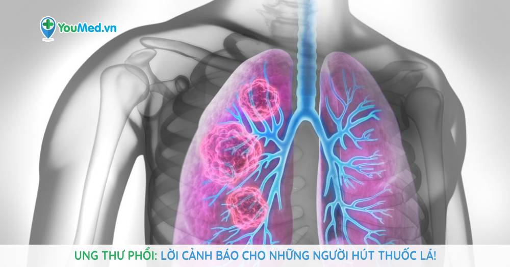 Ung thư phổi: Lời cảnh báo cho những người hút thuốc lá!