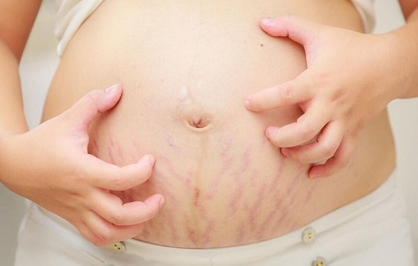 vết rạn da khi mang thai tuần 13