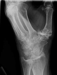 X-quang viêm khớp ngón tay cái