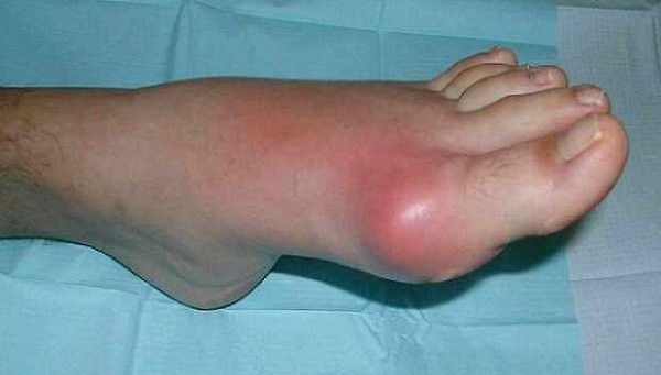Minh họa sưng, đỏ khớp bàn ngón chân cái ở một trường hợp bị cơn gút cấp