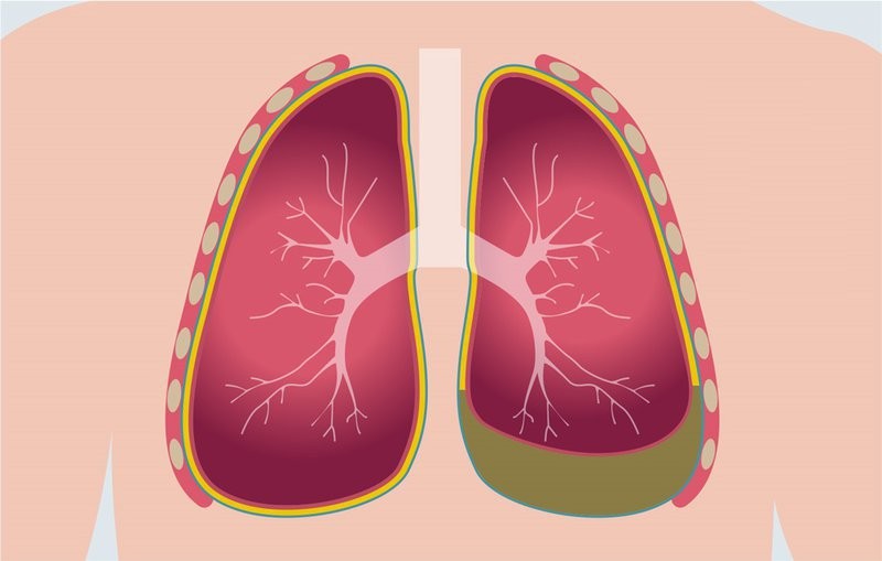 Màng phổi bình thường (trái) và màng phổi bị viêm (phải)