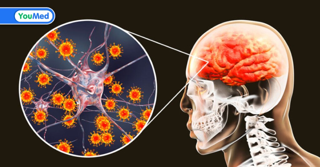 Viêm não Nhật Bản: Nguyên nhân, triệu chứng và cách điều trị