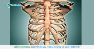 Viêm sụn sườn: Nguyên nhân, triệu chứng và cách điều trị