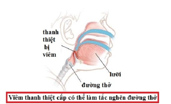 Viêm thanh thiệt cấp thường ảnh hưởng nhiều nhất ở trẻ em từ 2 đến 6 tuổi