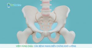 Viêm vùng chậu (PID): Căn bệnh mang biến chứng khó lường