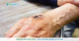 Viêm da mủ hoại thư: tổn thương đáng sợ ít gặp