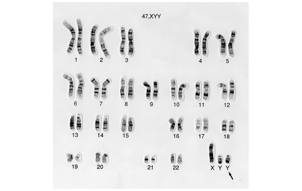 Hội chứng siêu nam xảy ra khi người nam có thêm một nhiễm sắc thể Y