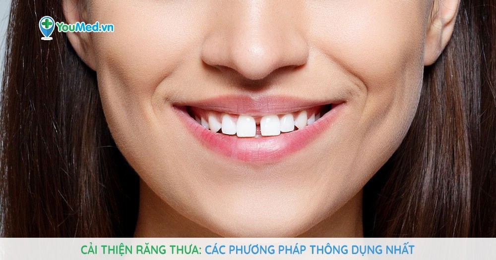 Cải thiện răng thưa - Các phương pháp thông dụng nhất