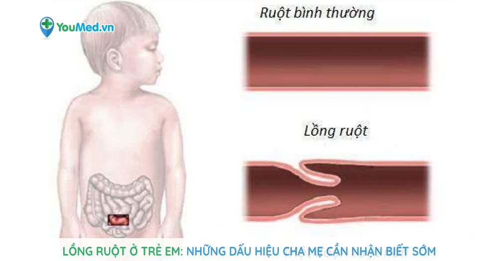 Lồng ruột ở trẻ em: Những dấu hiệu cha mẹ cần nhận biết sớm