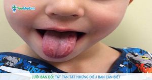 Lưỡi bản đồ: Nguyên nhân, triệu chứng và cách điều trị