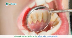 Làm thế nào để ngăn ngừa mảng bám và vôi răng?