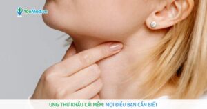 Ung thư khẩu cái mềm: Mọi điều bạn cần biết