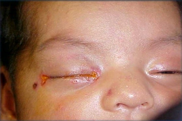 Viêm kết mạc mắt ở trẻ em do vi khuẩn lậu