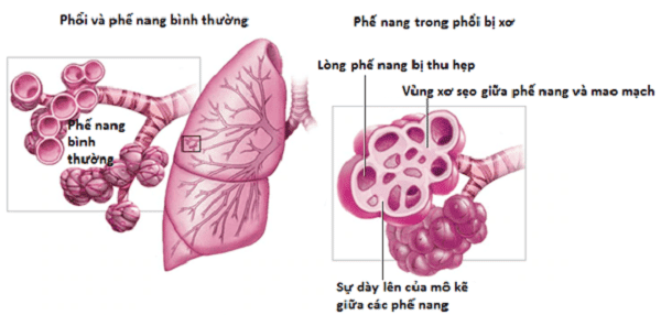 Bệnh phổi mô kẽ và những điều cần biết - YouMed