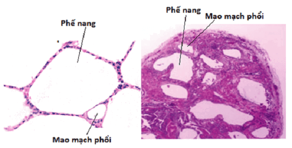 Hình trên kính hiển vi của phổi bình thường (trái) và phổi xơ hoá (phải)