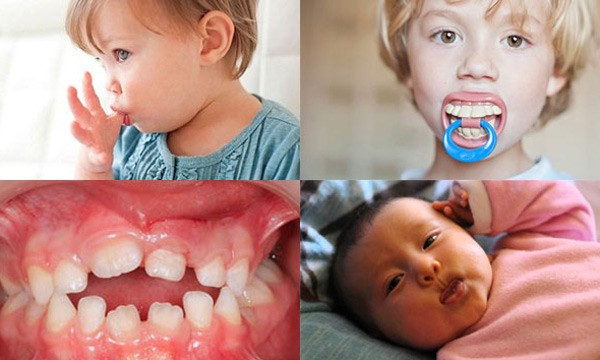 Một vài thói quen xấu của trẻ sẽ tạo ra khe hở trên răng