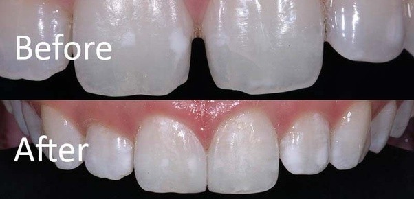 Hình ảnh trước và sau khi trám răng