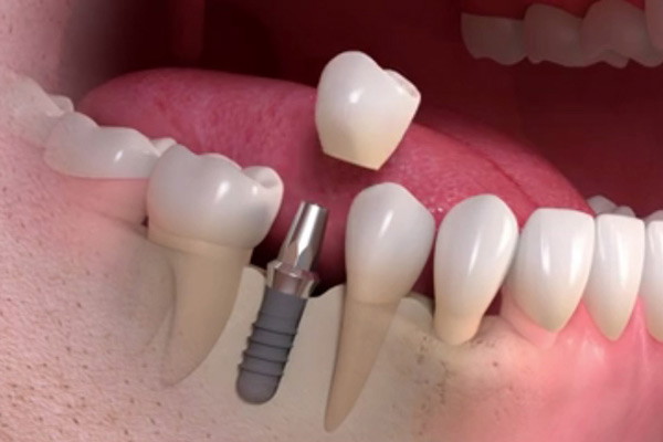 Phương pháp implant