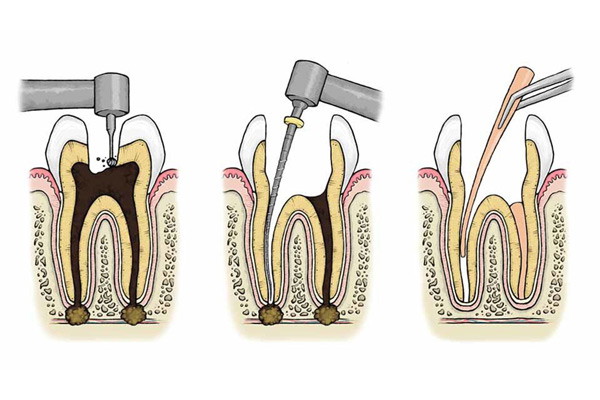 Điều trị do sâu răng