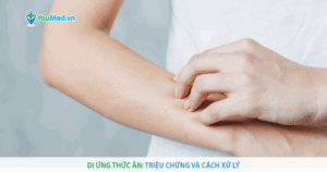 Dị ứng thức ăn: những điều bạn cần biết và cách phòng ngừa