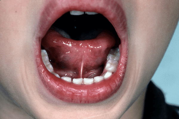 Dính thắng lưỡi thường thấy ở trẻ nam hơn