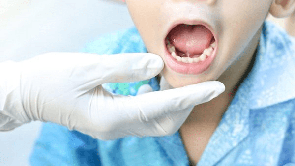 Có thể chẩn đoán dính thắng lưỡi dựa vào việc khám lâm sàn