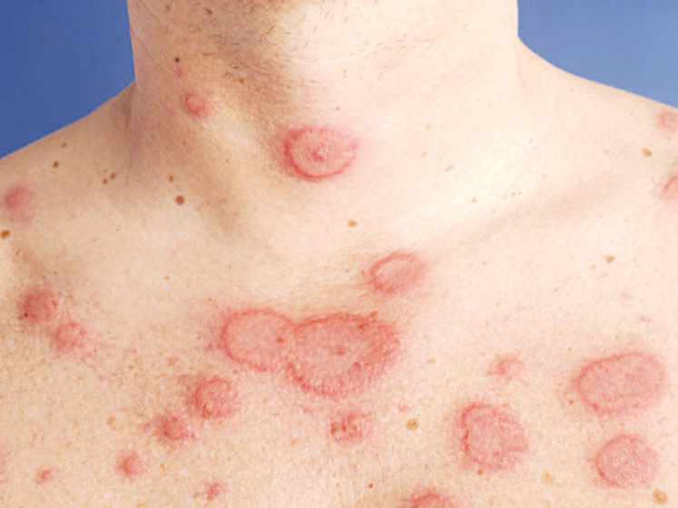 Lupus ban đỏ là một trong những nguyên nhân gây hẹp van 2 lá