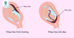 Nhau tiền đạo: Định nghĩa, dấu hiệu, thông tin xử trí?