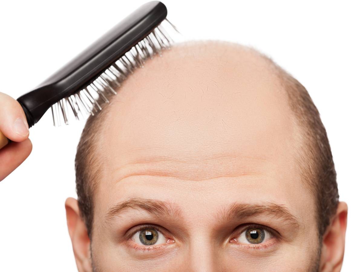DHT Blocker là gì có giúp giảm rụng tóc hói đầu