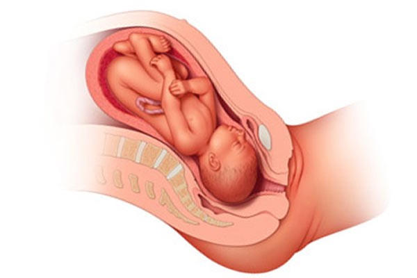 Tư thế thai: Đầu hướng về phía cổ tử cung, cằm gặp vào ngực. Cổ tử cung mở ra để đầu thai lọt vào âm đạo ra ngoài