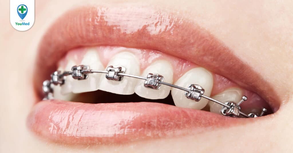 Những tác hại của niềng răng mà bạn có nguy cơ gặp phải