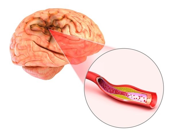 thiếu máu não là một trong những biến chứng nguy hiểm của viêm động mạch Takayasu