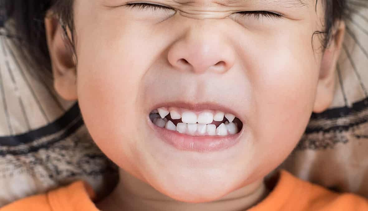 Nghiến răng có thể gây ảnh hưởng xấu đến răng miệng của trẻ